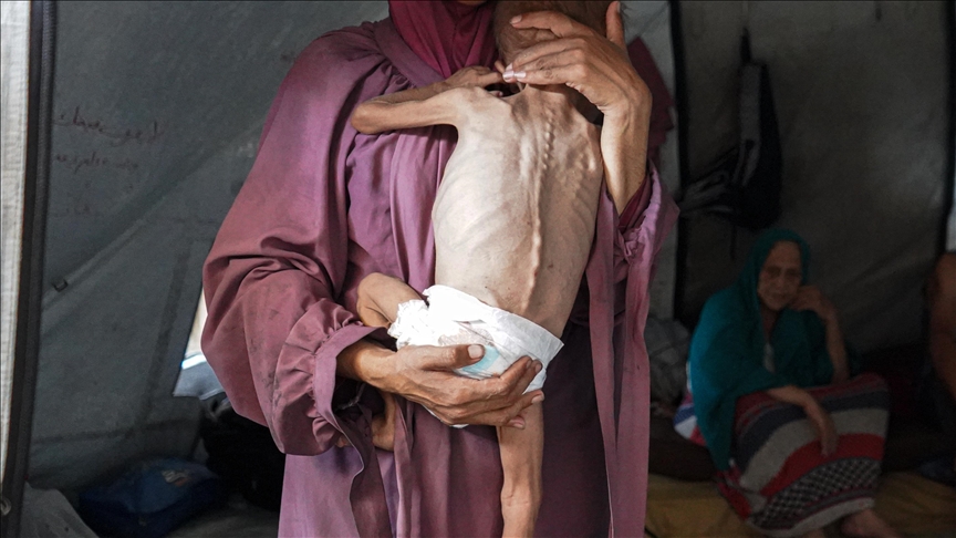 Fëmijët që vdesin nga kequshqyerja në Gaza, fytyra më e dhimbshme e krizës humanitare