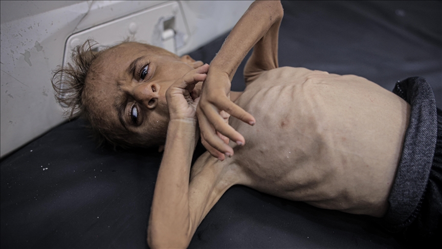 Emaciated Palestinian child embodies Gaza’s starvation crisis despite Israeli denial