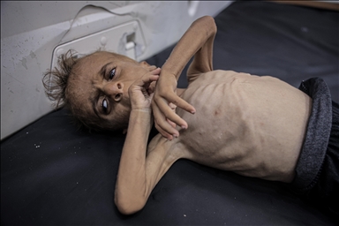 Fotografija jednoipogodišnjeg Mohammada razotkriva izraelsku politiku izgladnjivanja