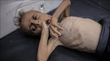 Emaciated Palestinian child embodies Gaza’s starvation crisis despite Israeli denial