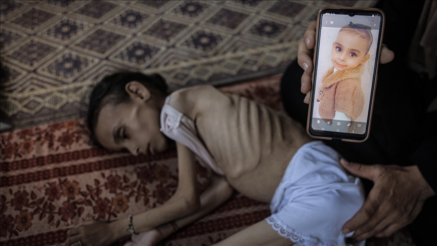 Merjemja 9-vjeçare nga Gaza humbet aftësinë për të ecur për shkak të urisë