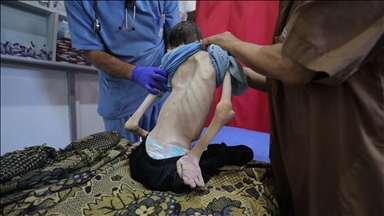 غزة.. ارتفاع وفيات التجويع الإسرائيلي إلى 162 فلسطينيا بينهم 92 طفلا 