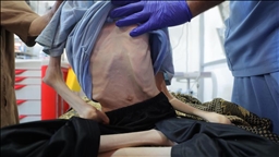 Një adoleshent palestinez vdes nga uria në Gaza për shkak të kufizimeve izraelite të ndihmave