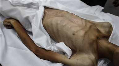 غزة.. ارتفاع وفيات التجويع الإسرائيلي إلى 180 بينهم 93 طفلا 