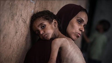 "انتشار مقلق".. صحة غزة تسجل 95 إصابة بمتلازمة غيلان باريه النادرة 