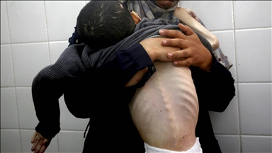 Një fëmijë tjetër vdes nga uria në Gaza mes rrethimit të vazhdueshëm izraelit