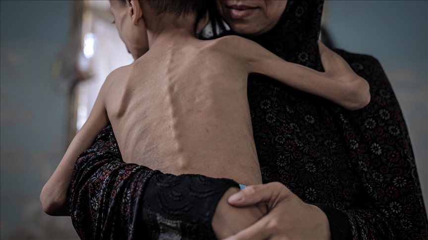 تجويع إسرائيلي وسوء تغذية.. الموت يتربص بـ15 طفلا في مستشفى بغزة (تقرير)