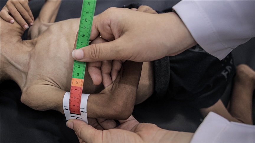 UN reports deepening starvation and malnutrition in Gaza, especially among children