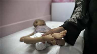 WHO says 99 people, including 29 children, died of malnutrition in Gaza this year