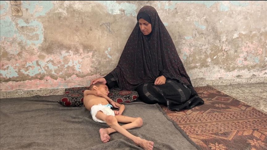 غزة.. الطفل نافذ يصارع التجويع والمرض بجسد نحيل (تقرير)