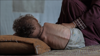 Gaza : 148 Palestiniens morts de malnutrition en raison du blocus israélien de l’aide, selon l’OMS