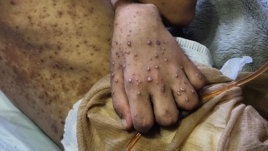 Gaza bilježi nagli porast kožnih bolesti usred jakog toplotnog talasa