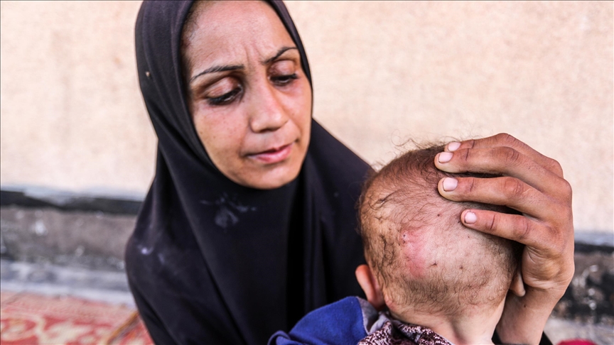 No milk, no medicine: Gaza baby’s skin rots as war and hunger tighten their grip