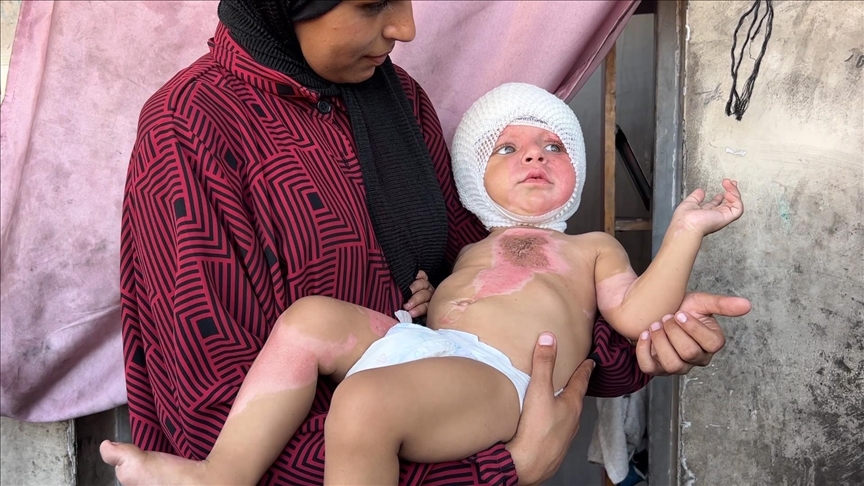İsrail saldırısından derin yanıklarla kurtulan Gazzeli bebeğin ailesi destek bekliyor