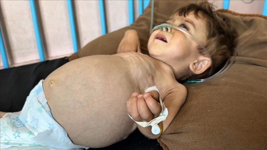 كريم.. طفل بغزة بين فكي مرض نادر وتجويع إسرائيلي (تقرير)