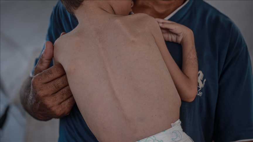 Gaza : un bébé de 5 mois meurt de faim dans le territoire