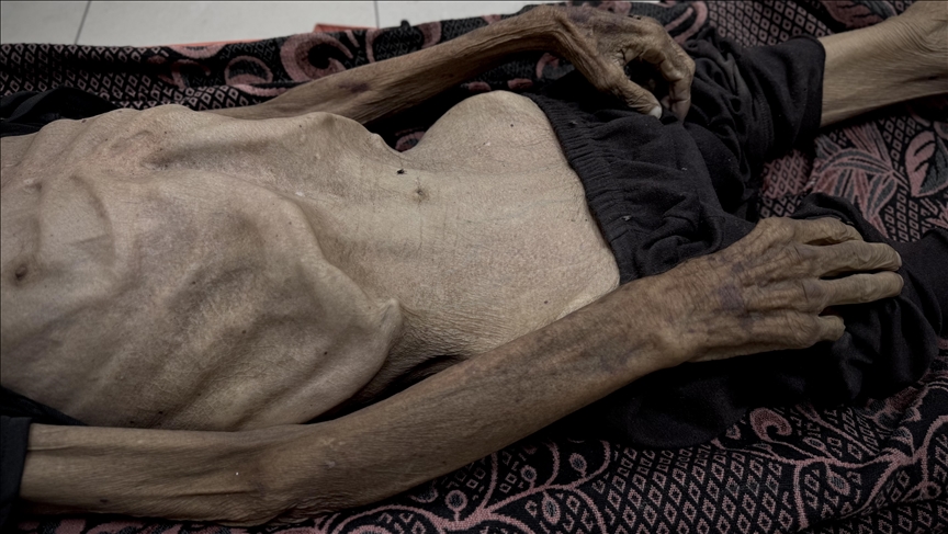 Famine claims 8 more lives in Israel-blockaded Gaza