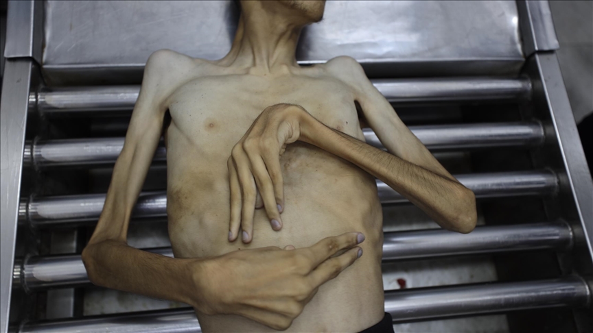 صحة غزة: حصيلة وفيات التجويع الإسرائيلي 322 بينهم 121 طفلا 
