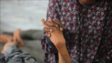 Famine claims 5 more lives in Israel-blockaded Gaza 