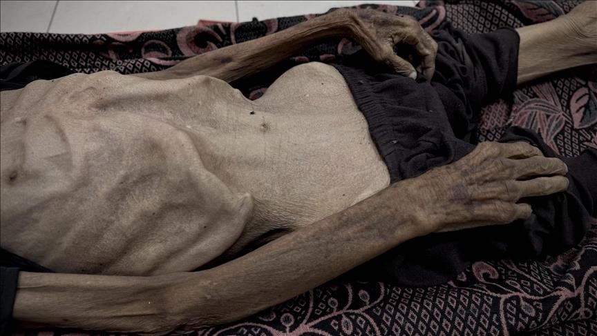 Over 1,000 adults in Gaza diagnosed with malnutrition in 3 weeks amid Israeli siege