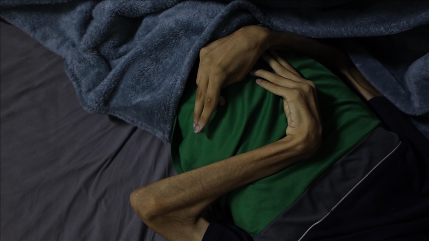 Famine claims 10 more lives in Israel-blockaded Gaza 