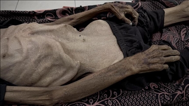Over 1,000 adults in Gaza diagnosed with malnutrition in 3 weeks amid Israeli siege
