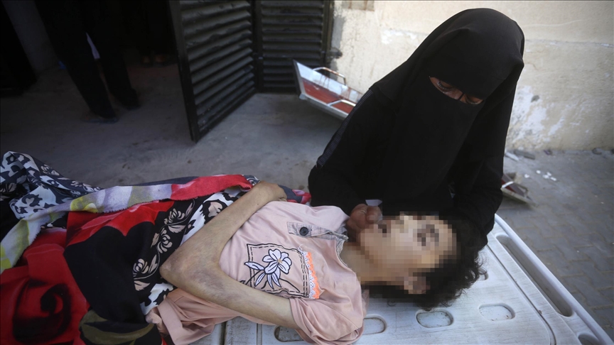 صحة غزة: ارتفاع وفيات التجويع الإسرائيلي لـ339 بينهم 124 طفلا