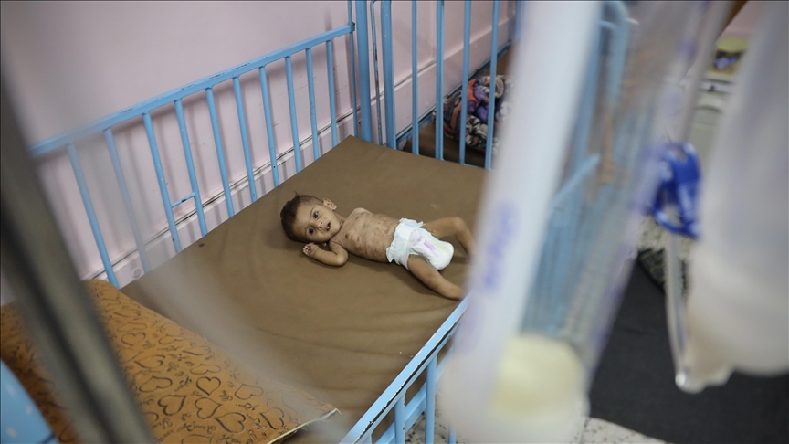 Izgladnjela jednoipogodišnja palestinska beba bori se za život