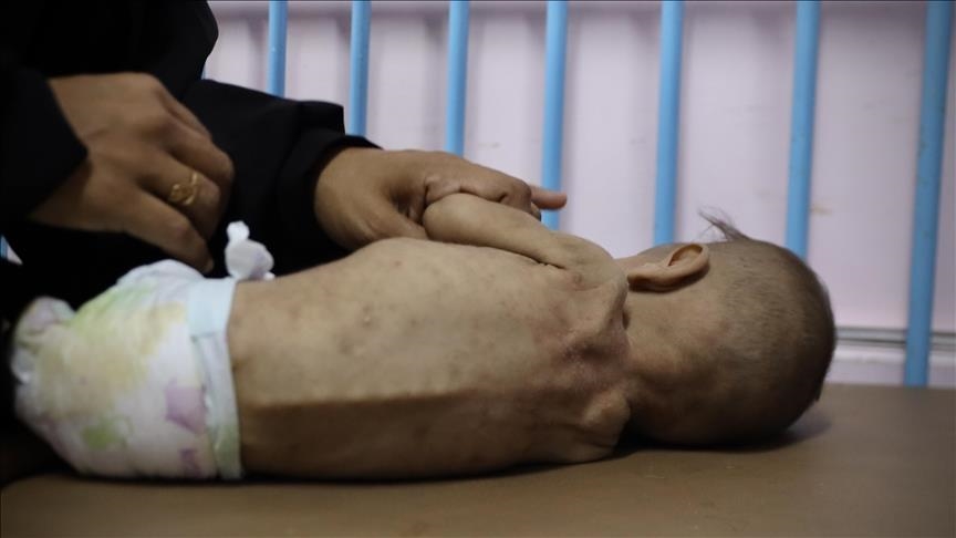 Palestinska beba pati od teške pothranjenosti usred izraelske blokade Gaze