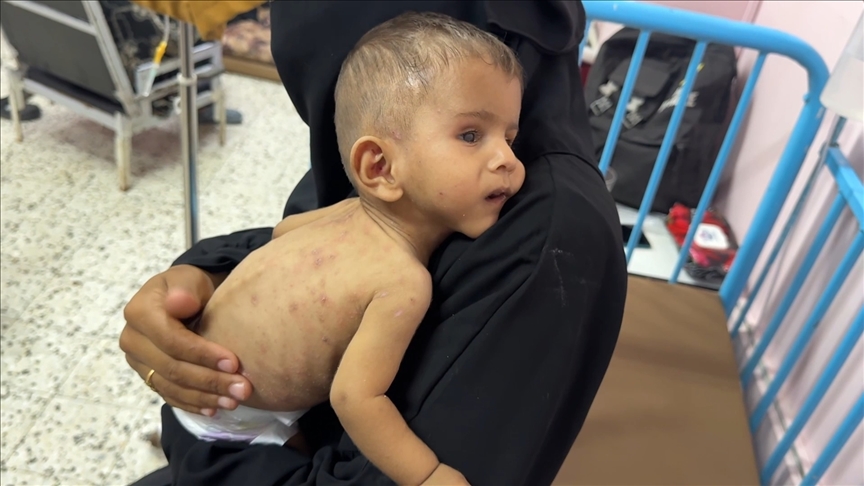 İsrail'in uyguladığı abluka ve sistematik açlık politikasının küçük kurbanı Ali yaşam mücadelesi veriyor