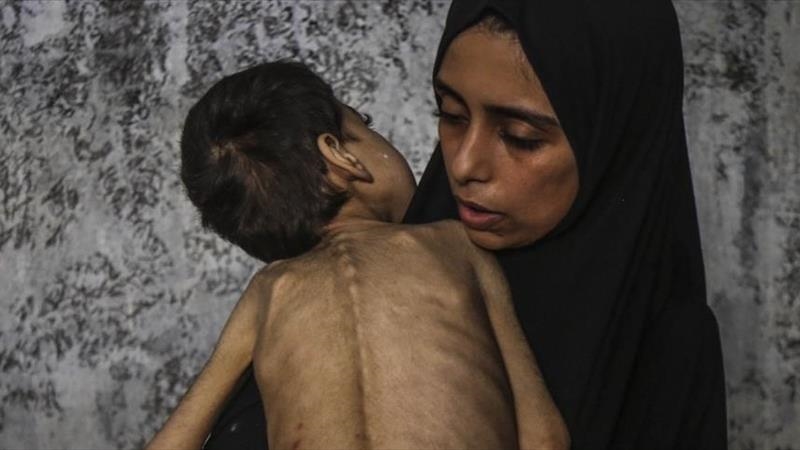 Në 24 orët fundit në Gaza vdesin nga uria 6 persona të tjerë, përfshirë dy fëmijë