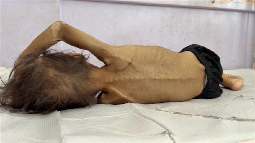  Двегодишно дете осудено на глад од Израел се бори за живот во Газа
