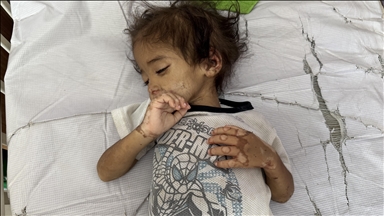 Vogëlushi nga Gaza në luftë për mbijetesë për shkak të urisë së imponuar nga Izraeli