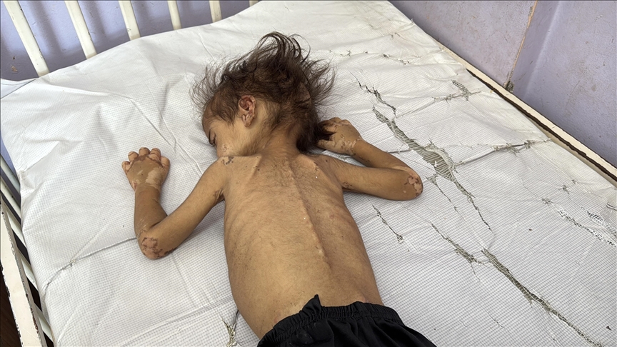 Gaza : 7 Palestiniens, dont 2 enfants, meurent de malnutrition, le bilan atteint 420