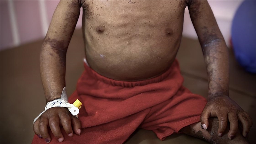 غزة.. أطفال يذبلون جوعا ومرضا بفعل الإبادة الإسرائيلية 