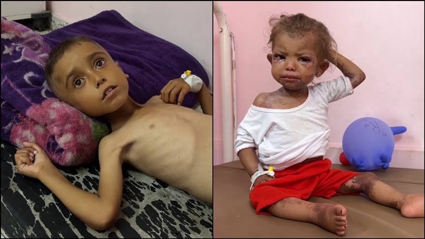 Yetersiz beslenme kaynaklı can kayıplarının arttığı Gazze'de hastanelerdeki çocuklar adeta ölümü bekliyor