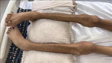 غزة.. ارتفاع وفيات التجويع الإسرائيلي إلى 428 بينهم 145 طفلا 