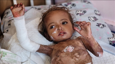 Gazze'de kelebek hastası Yakin bebek, tıbbi malzeme eksikliği ve İsrail ablukasının pençesinde