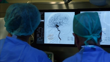 Huntington's disease successfully treated for 1st time in UK