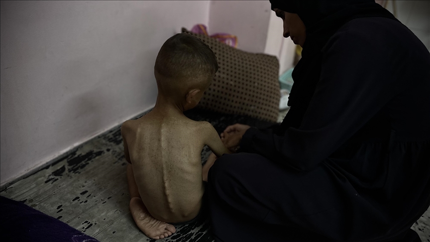 غزة.. ارتفاع وفيات التجويع الإسرائيلي لـ460 بينهم 154 طفلا