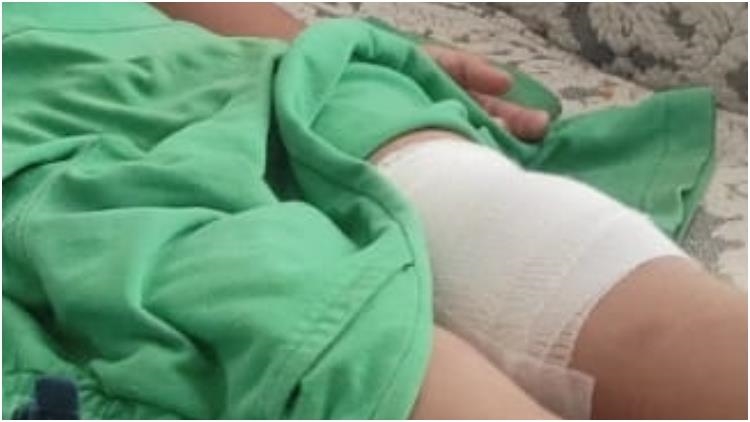 Bursa'da sahipsiz köpeğin saldırdığı çocuk bacağından yaralandı