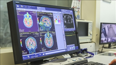 Men’s brains age faster than women’s, but that may not explain Alzheimer’s gap, study finds