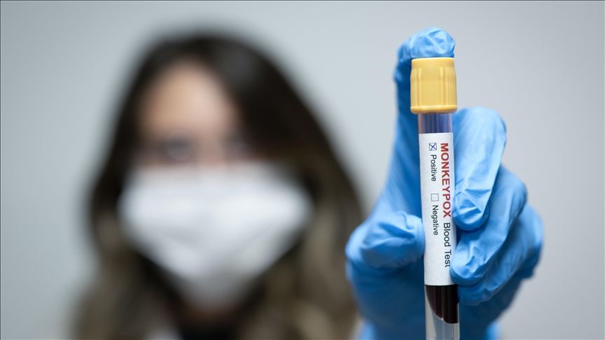 Portugal comunica que se han confirmado 29 casos de viruela símica (MPXV) en los últimos tres meses