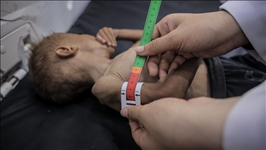 يونيسف: 9 آلاف طفل دون 5 سنوات في غزة يعانون سوء تغذية حاد