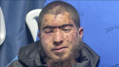 Vücudu işkence izleriyle kaplı Filistinli genç, gaspçı İsrailliler ile askerin uyguladığı vahşeti AA'ya anlattı