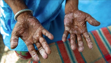 Hrvatska: Radniku iz Nepala potvrđena bolest gube