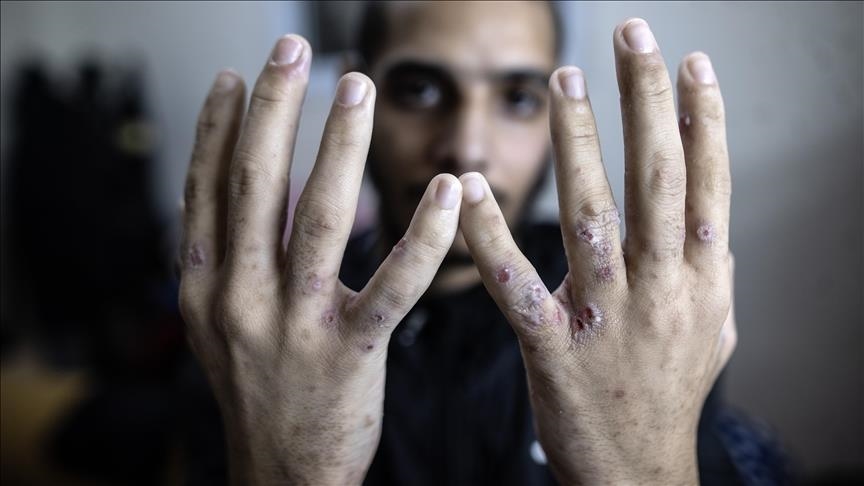 إعلام الأسرى: تفاقم انتشار الجرب والقمع ضد فلسطينيين بسجن إسرائيلي