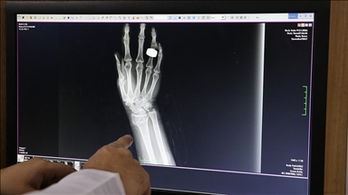 Kar ve buzlanma nedeniyle düşmeye bağlı kırık vakalarında son günlerde artış yaşanıyor