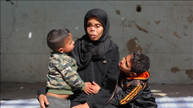 İsrail saldırısında yüzünün bir kısmını kaybeden Gazzeli annenin tek dileği çocuklarının kokmadan ona sarılması