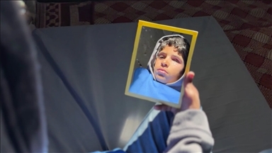 Gazze'de şarapnel nedeniyle gözünü kaybeden çocuk, protez gözle normal hayatına dönmeyi umut ediyor